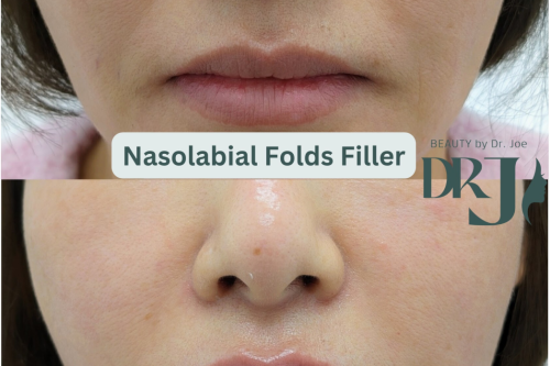 Nasolabial-Folds-Filler2