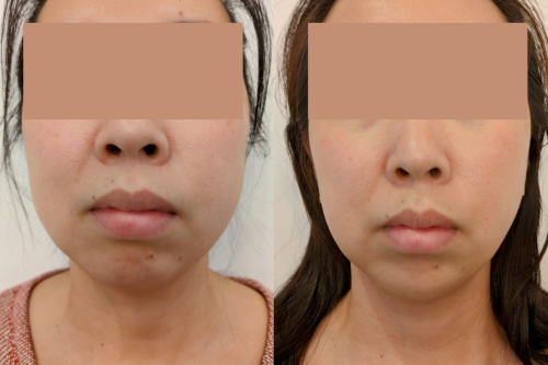 Jaw Slimming + Chin Filler - 1