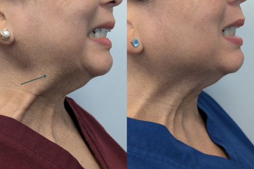 BOTOX Nefertiti Neck Lift - 1